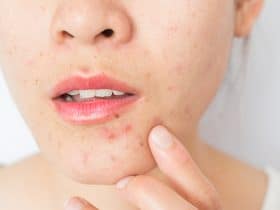 acne prone mouth